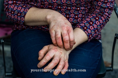 Dyshidrotic eczema