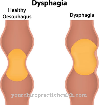 Dysphagia