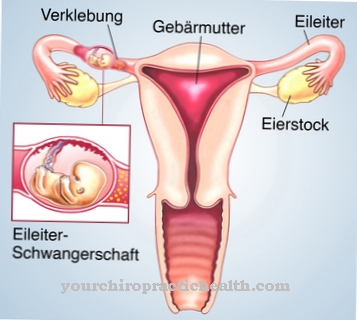 Ectopic pregnancy