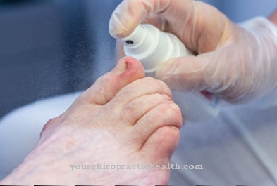 Ingrown toenail