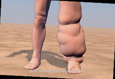 Elephantiasis