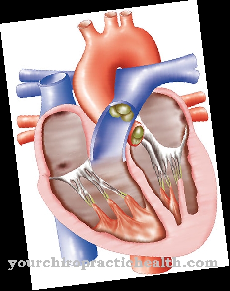 Endocarditis