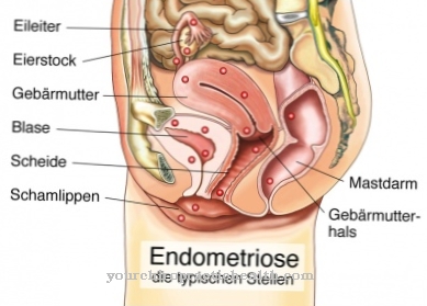 Az endometriózis