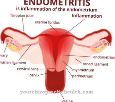 endometritis