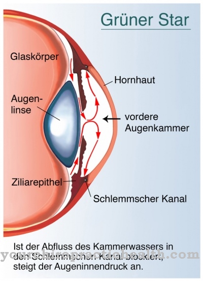 Glaukoma sudut tertutup