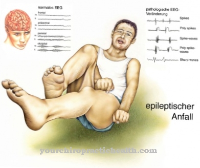 epilepsija