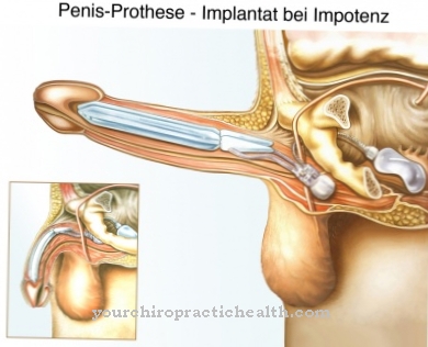 Erectile dysfunction (erectile impotence)