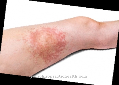 Erythema