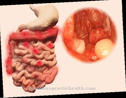 Familial adenomatous polyposis