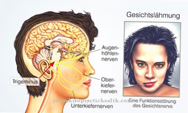 Facial paralysis (facial paralysis)