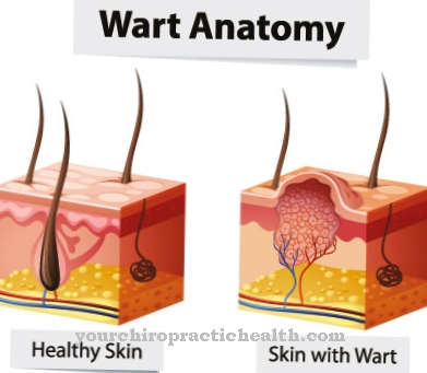 الثآليل التناسلية (HPV)