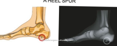 Heel spur