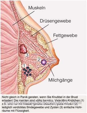 Adipose tissue necrosis in the chest