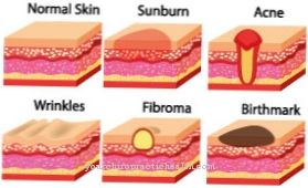 Fibroma