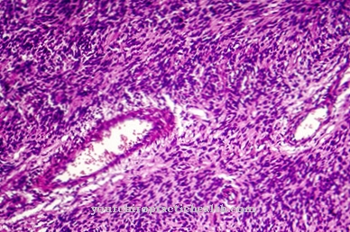 Fibrosarcoma