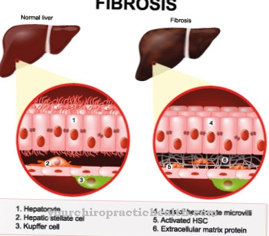 Fibrose (sclérose)