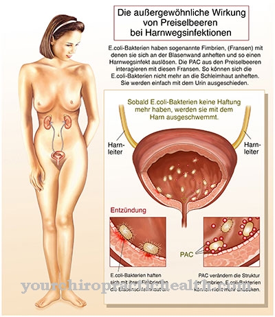 Honeymoon cystitis (cystitis)