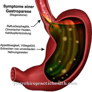 Gastroparesis