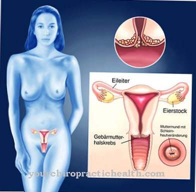 cervical cancer