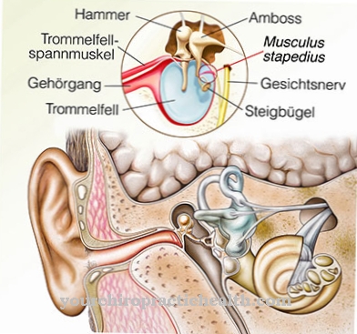 Exostosis תעלת האוזן