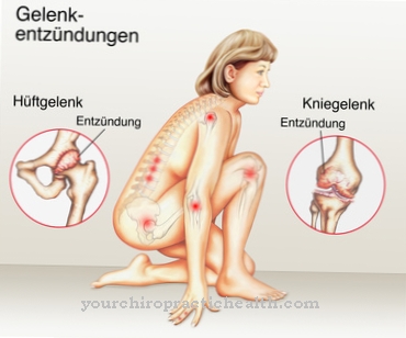 Niveltulehdus (niveltulehdus)