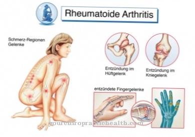 Joint disease