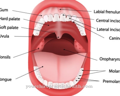 Hiperplasia gingiva