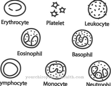 Glanzmann's thrombasthenia