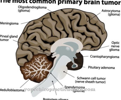 Glioma