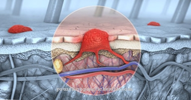 Gorlin-Goltz Syndrome