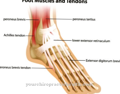 Haglund syndrome (Haglund heel)