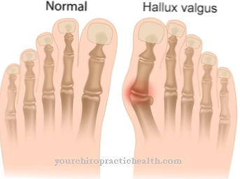 Hallux Valgus (oignon)