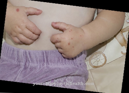 Hand, foot and mouth disease