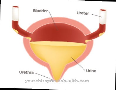 Bladder diverticulum