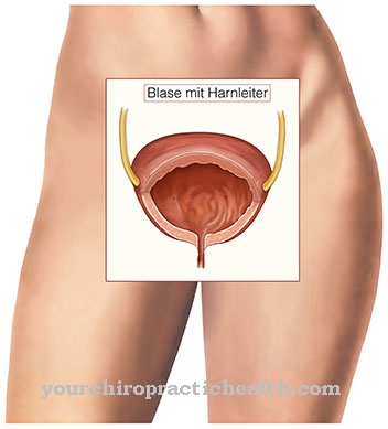 Ureteral akmens