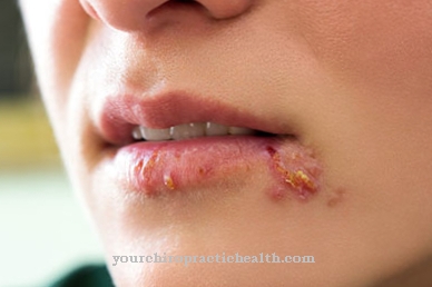 Herpes simplex