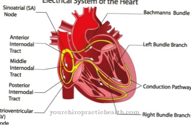 Heart defect