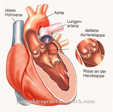 Doença cardio vascular