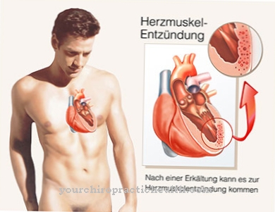 Myocarditis