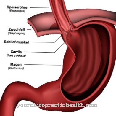 Hiatale hernia