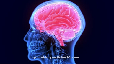 Increase in intracranial pressure