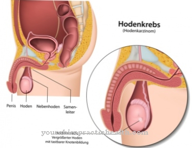 Cancer testicular