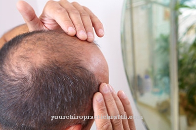 Hormonális örökletes hajhullás (alopecia androgenetica)