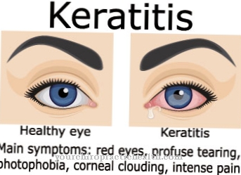 Corneal inflammation