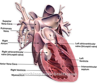 Cardiomyopathie hypertrophique