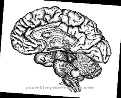 Infantile cerebral palsy