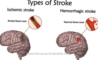 Perdarahan intraserebral