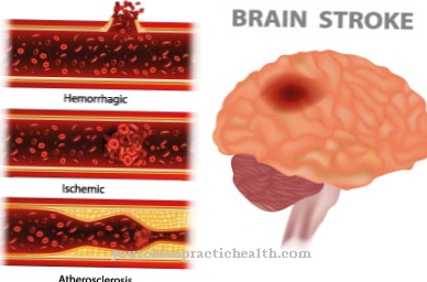 Ischemia