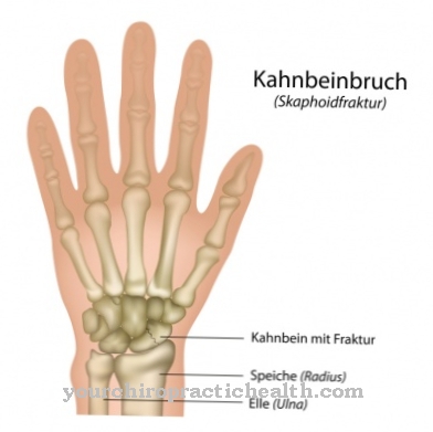 Scaphoid fracture