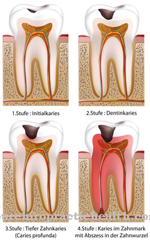 Caries